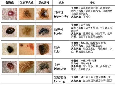 臉部黑痣|是痣還是瘤？黑色素瘤的類型、症狀與治療